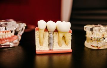 Dental Implant Benefits Image