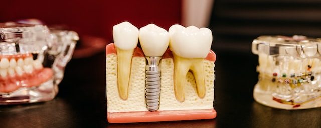 Dental Implant Benefits Image