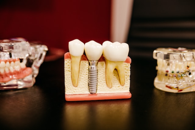Dental Implant Benefits Image
